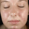 Gentle Chemical Peel