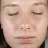 Gentle Chemical Peel