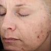 The Vitalize Peel®