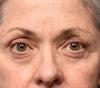 Sofwave™ Brow and Eyes