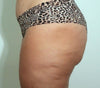 Sofwave™ Body