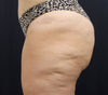 Sofwave™ Body