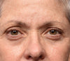 Sofwave™ Brow and Eyes