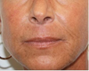 SmartSkin® CO2 – Perioral (3)