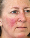 Sciton ClearV® for Rosacea - Face