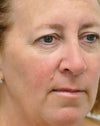 Sciton ClearV® for Rosacea - Face
