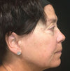 Sciton Forever Young BBL® - Neck